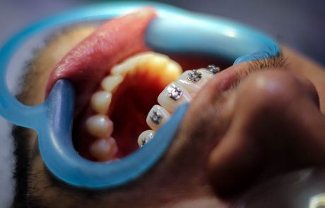 מה החשיבות של טיפולי יישור שיניים (אורתודונטיה)? 